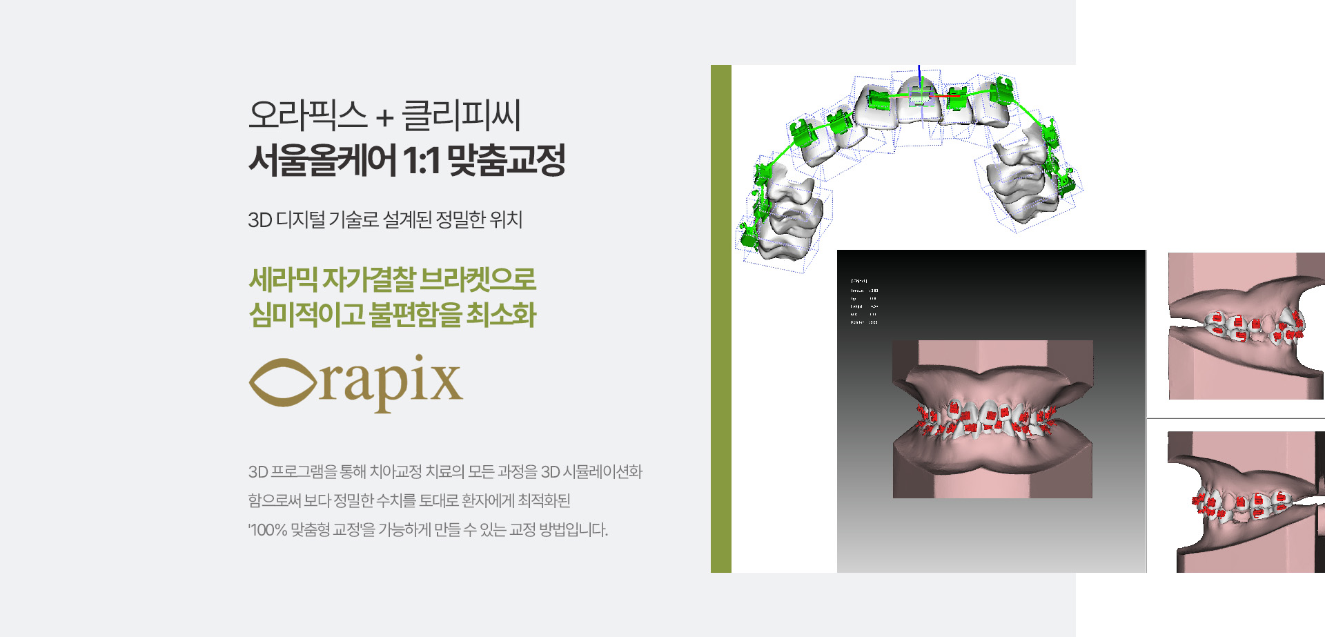 오라픽스 + 클리피씨 서울올케어 1:1 맞춤교정